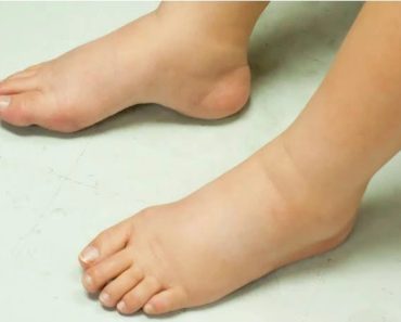 7 Medical Conditions That May Make You Have Swollen Legs And Ankles