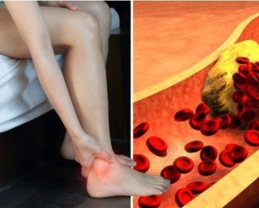 High cholesterol symptoms: The two visible signs on your legs – ‘Get your levels checked’