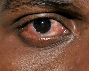 4 Common Eye Problems That Could Lead To Blindness If Not Treated Early