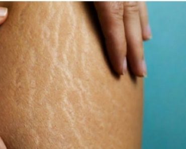 6 Natural Ways To Deal With Stretch Marks