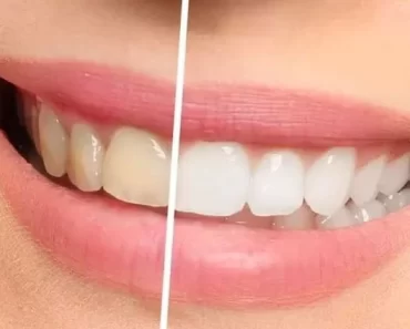 Smart Natural Ways You Can Remove Yellow Stains From Your Teeth