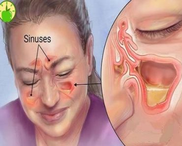 JUST IN: I have chronic sinus infection